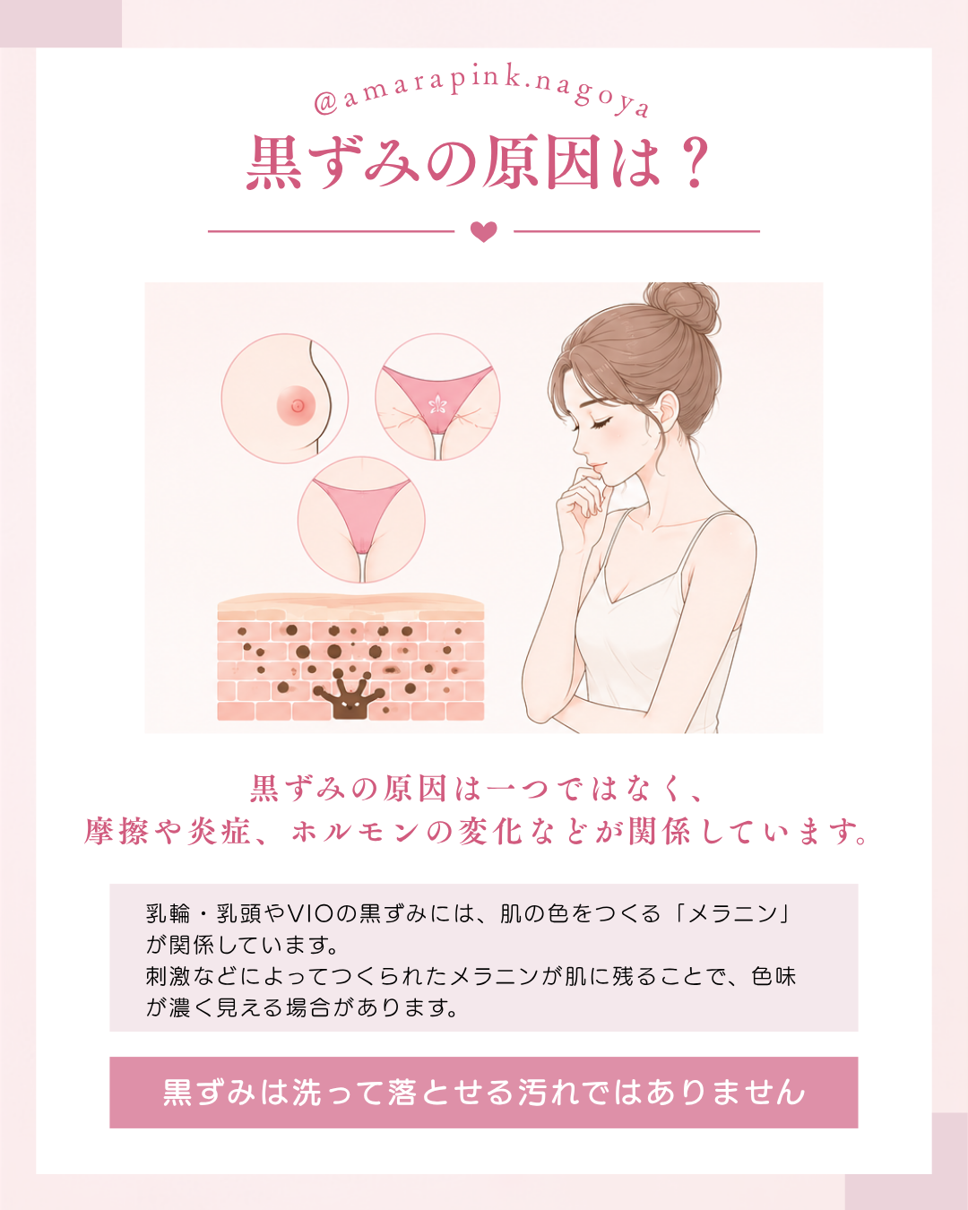乳輪・乳頭（バストトップ）やVIO・リップの黒ずみの原因は一つではなく、摩擦や炎症・ホルモンの変化によるものが関係しています。アマラピンク|JYUERIBROW|名古屋栄　【名古屋】アマラピンクで黒ずみ改善｜乳輪乳頭・VIO・リップの医療メラニンケア