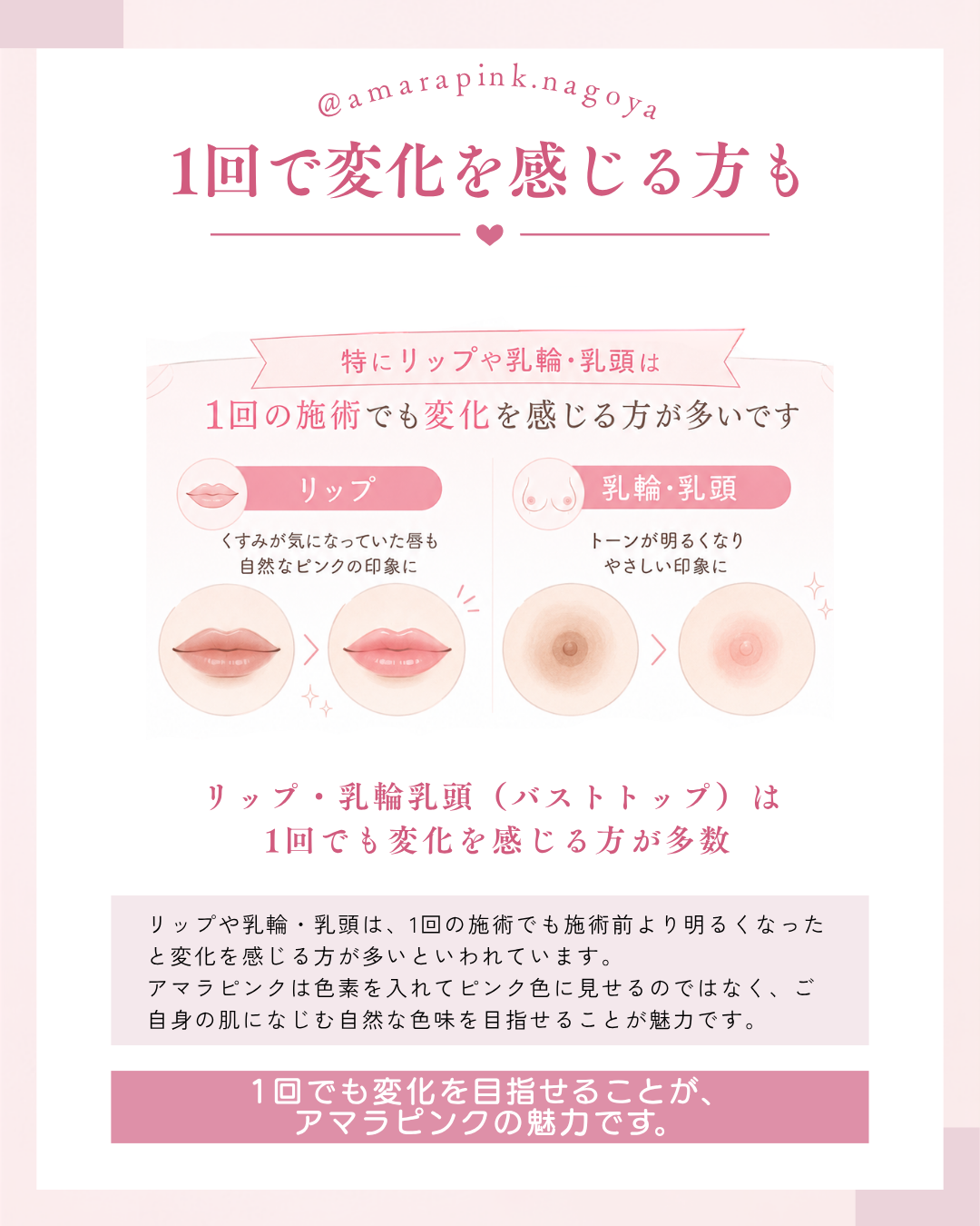 アマラピンクは、リップや乳輪・乳頭（バストトップ）の場合、１回の施術で変化を感じられる方が多くいます。アマラピンク|JYUERIBROW|名古屋栄　【名古屋】アマラピンクで黒ずみ改善｜乳輪乳頭・VIO・脇の医療メラニンケア